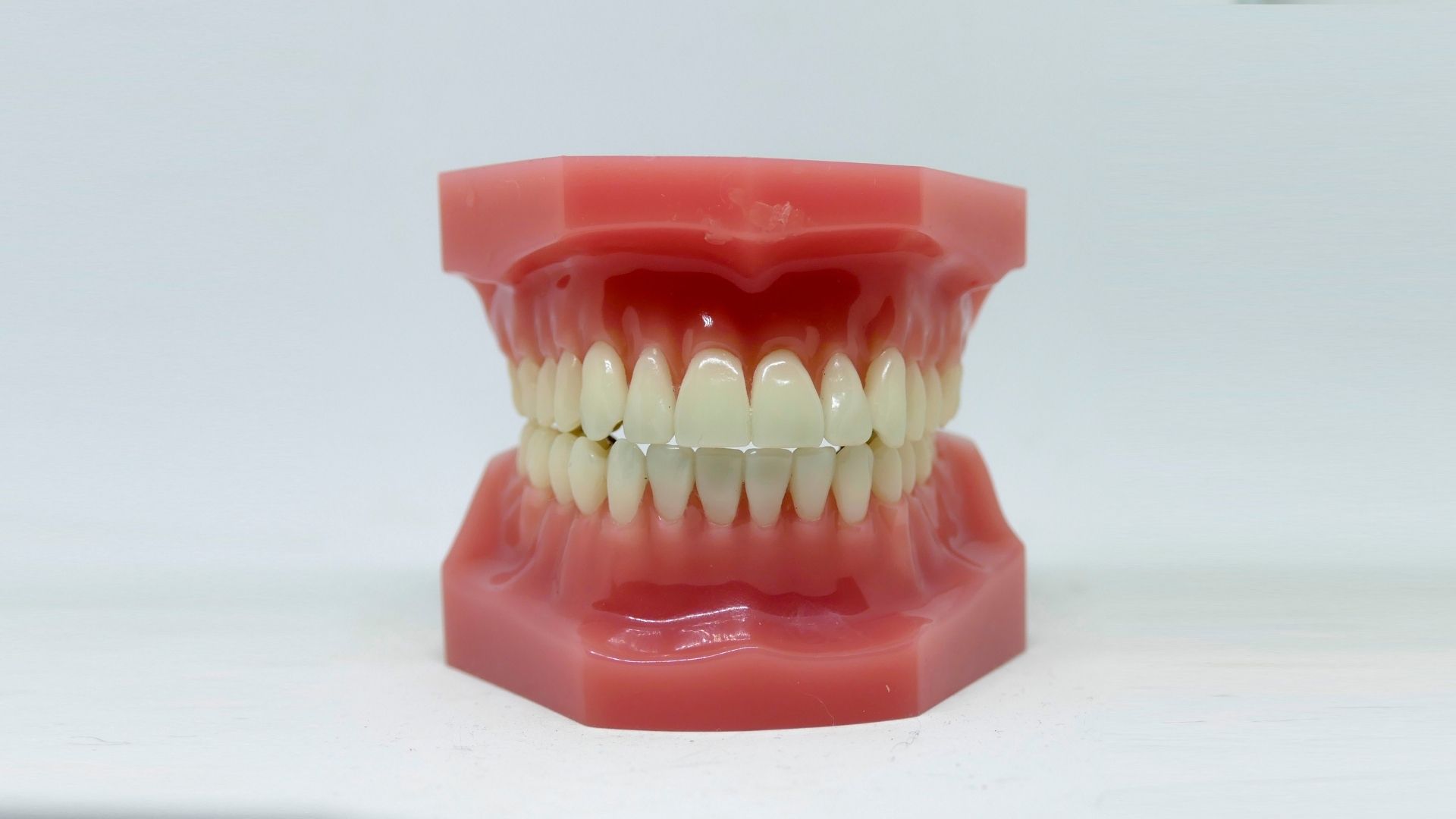 Fogászati implantátum típusok a MyDent Fogászat kínálatában